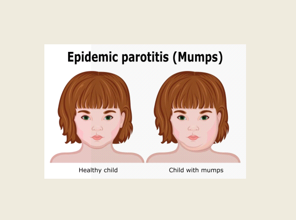 Mumps