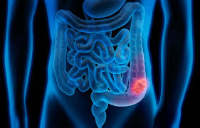 Colon cancer