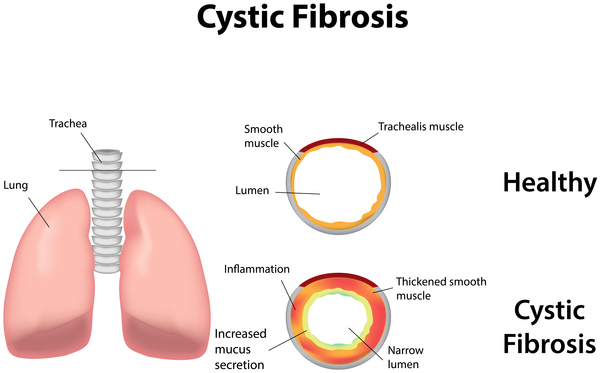 Cystic fibrosis