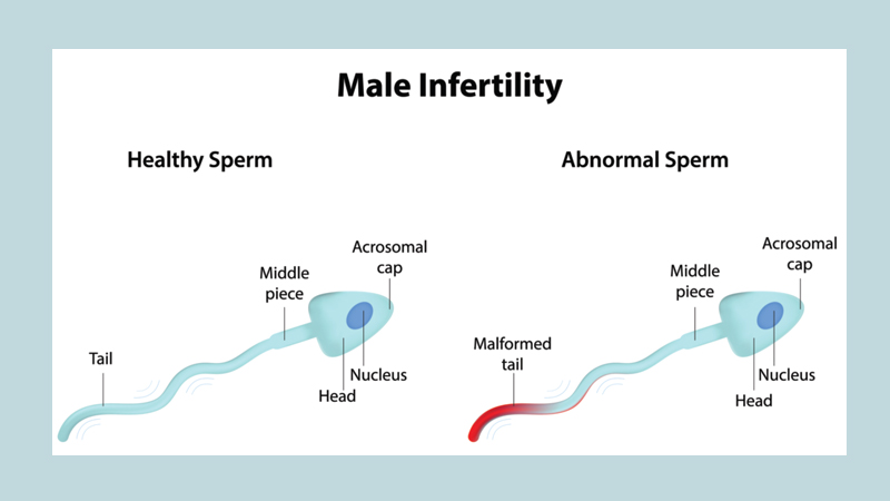 Infertility