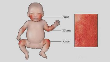 Impetigo