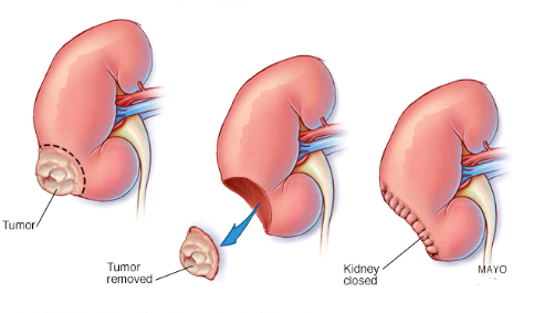 kidney cancer